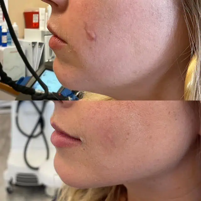 Frax 1550 Laser Treatment
