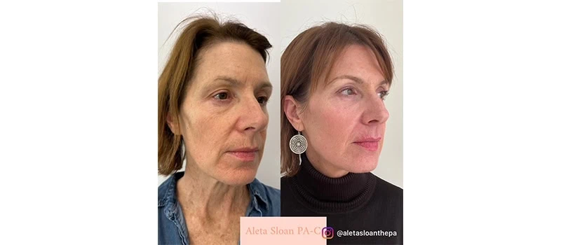 HELIX CO2 Laser Rejuvenation in Wilmington, NC | United Medical And Aesthetics