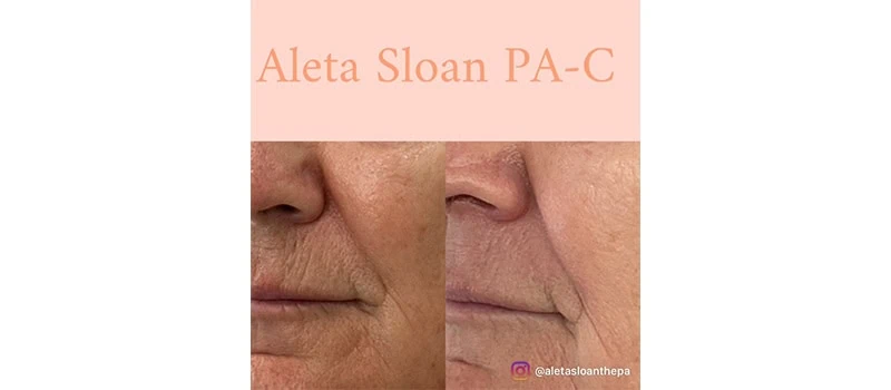 HELIX CO2 Laser Rejuvenation in Wilmington, NC | United Medical And Aesthetics