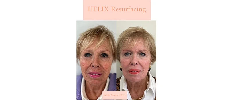 HELIX CO2 Laser Rejuvenation in Wilmington, NC | United Medical And Aesthetics