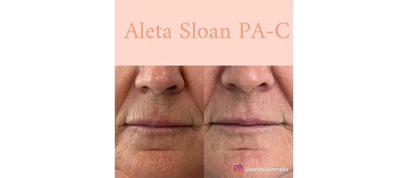 HELIX CO2 Laser Rejuvenation in Wilmington, NC | United Medical And Aesthetics