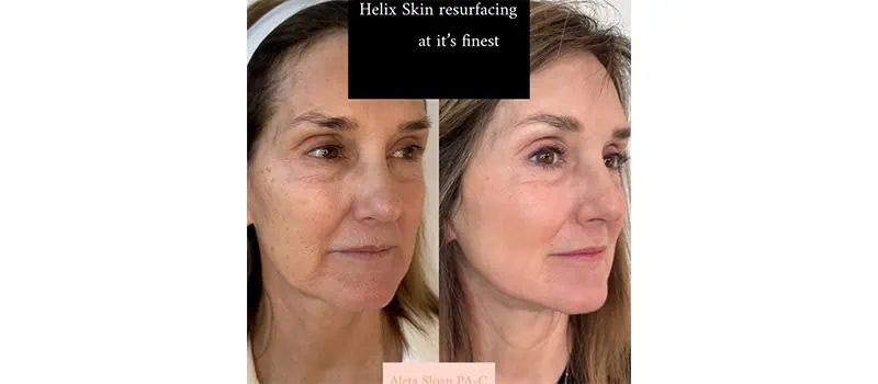 Helix in Wilmington, NC | United Medical And Aesthetics