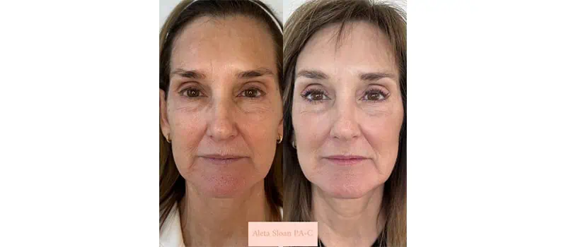 Helix in Wilmington, NC | United Medical And Aesthetics