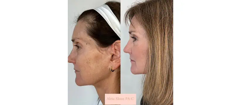 Helix in Wilmington, NC | United Medical And Aesthetics