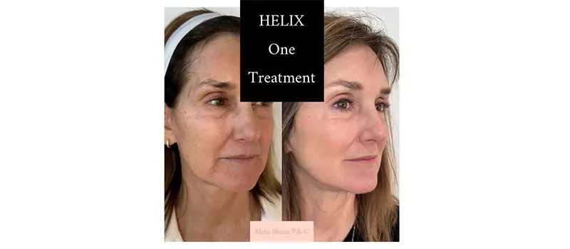 Helix in Wilmington, NC | United Medical And Aesthetics
