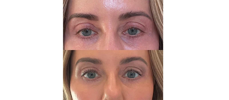 Non-Surgical Eye Lift in Wilmington, NC | United Medical And Aesthetics