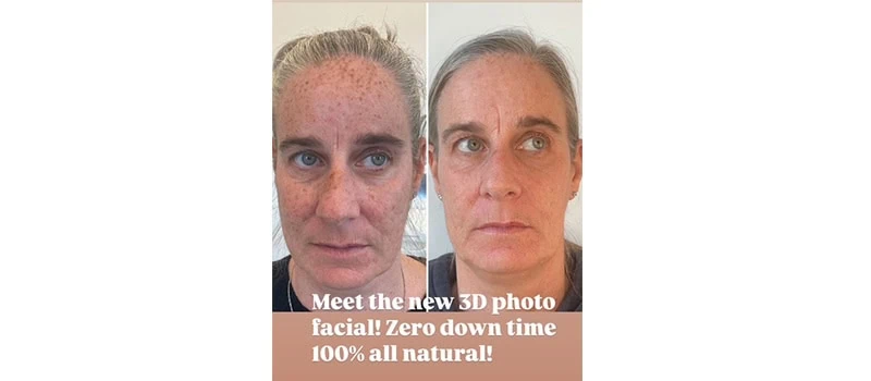 Nordyls Light and Bright in Wilmington, NC | United Medical And Aesthetics