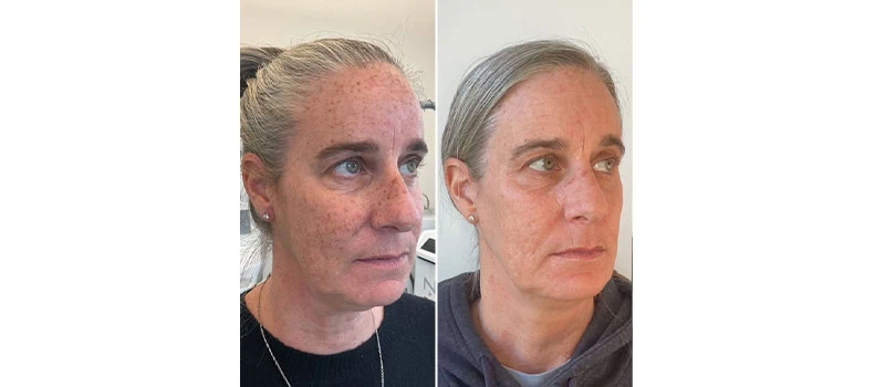 Nordyls Light and Bright in Wilmington, NC | United Medical And Aesthetics