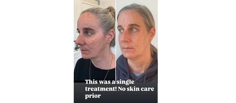 Nordyls Light and Bright in Wilmington, NC | United Medical And Aesthetics