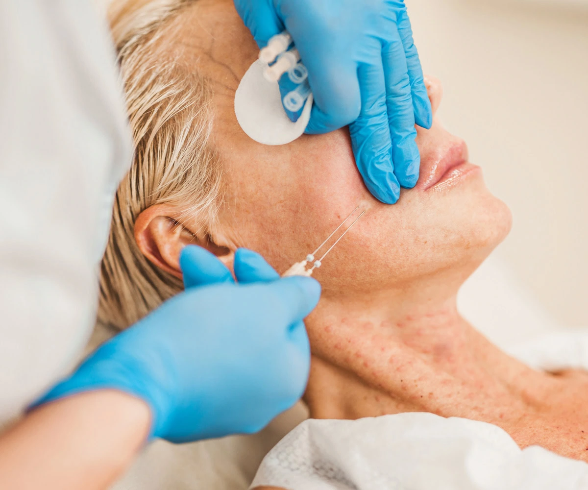 PDO Thread Lift Procedure in Wilmington, NC
