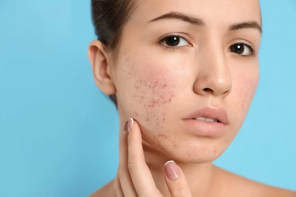 dermal filler in cheeks