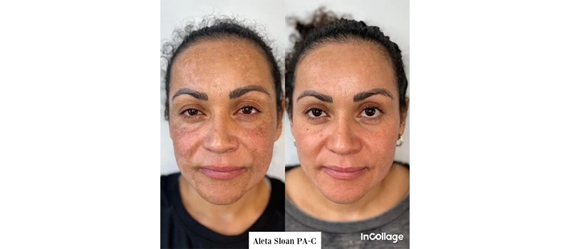 Skin Rejuvenation in Wilmington, NC | United Medical And Aesthetics
