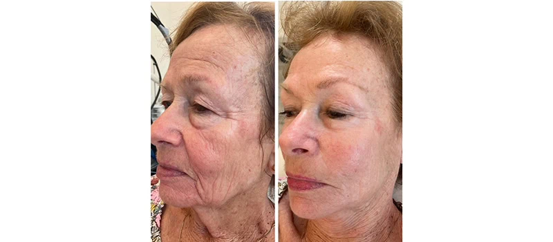 Skin Rejuvenation in Wilmington, NC | United Medical And Aesthetics