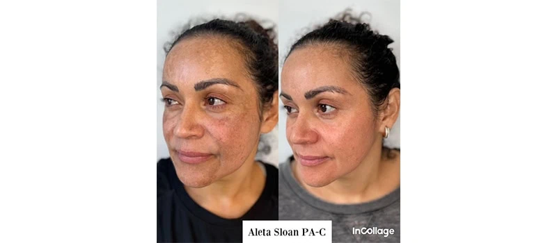 best fillers for face
