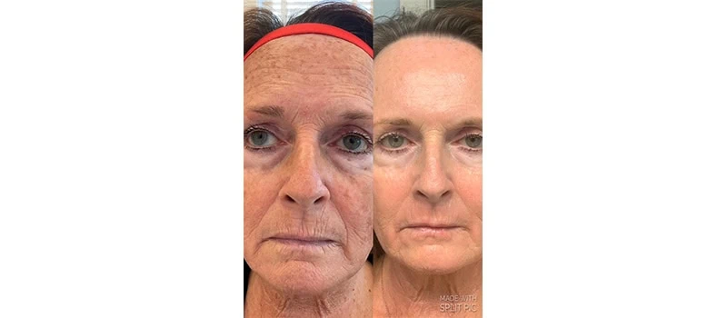 Skin Rejuvenation in Wilmington, NC | United Medical And Aesthetics