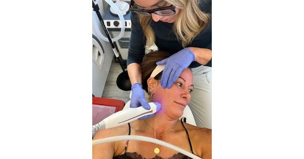 microneedling facial