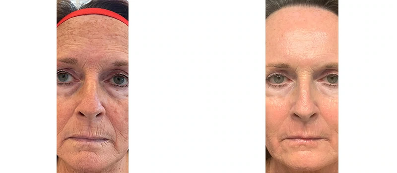 Co2 laser resurfacing