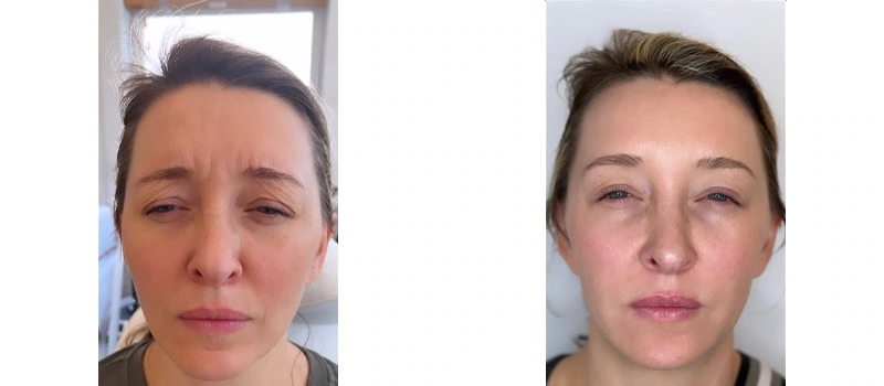 Botox Wilmington NC