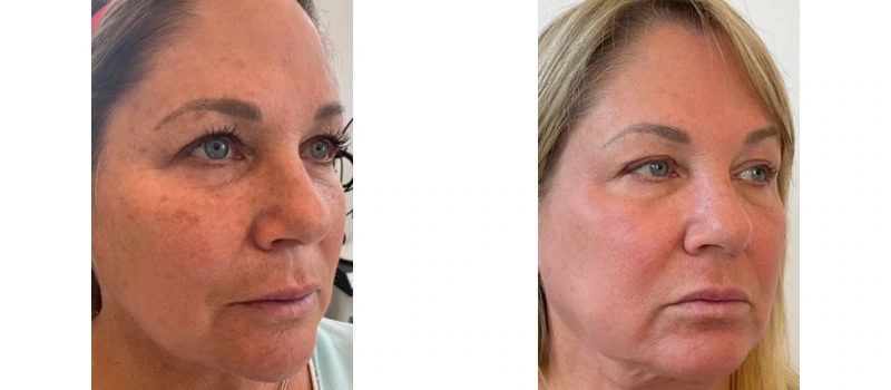 Co2 laser resurfacing