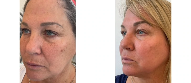 Co2 laser resurfacing