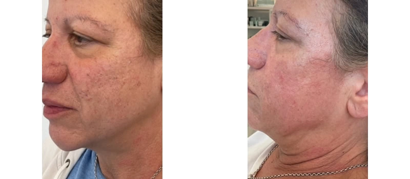Co2 laser resurfacing