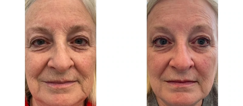 Co2 laser resurfacing