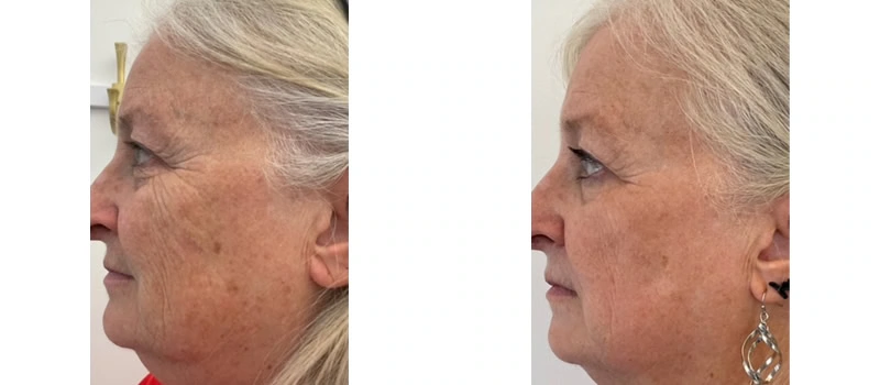 Co2 laser resurfacing