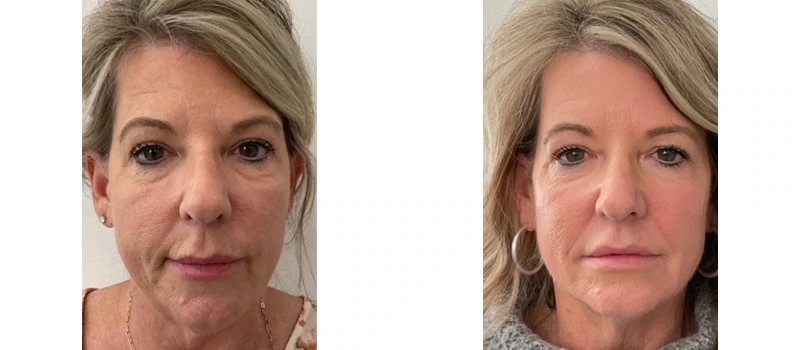 Co2 laser resurfacing