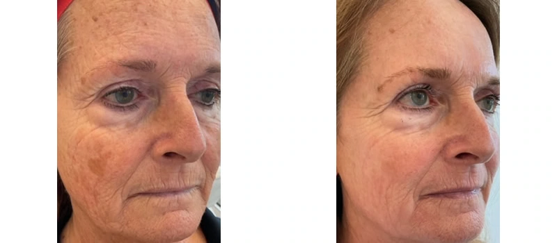 Co2 laser resurfacing