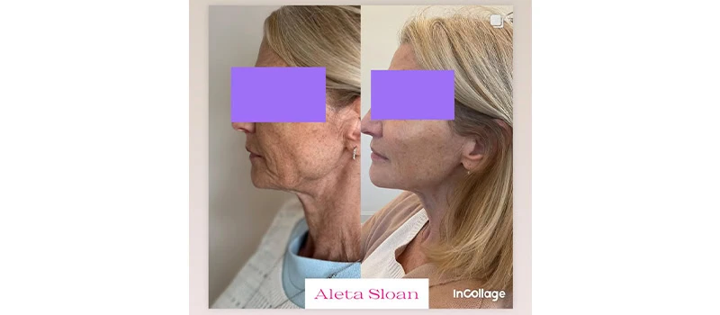 Dermal Filler in Wilmington, NC | United
