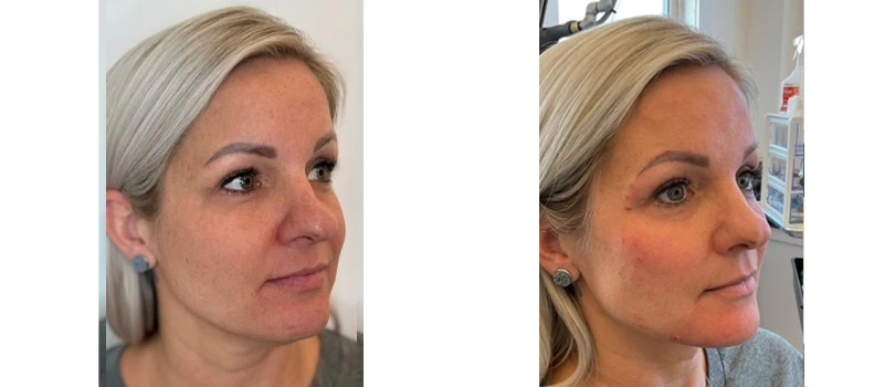 dermal fillers