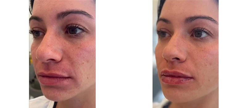 lip fillers