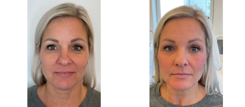 dermal fillers