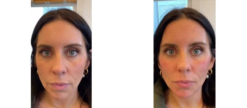 best fillers for face