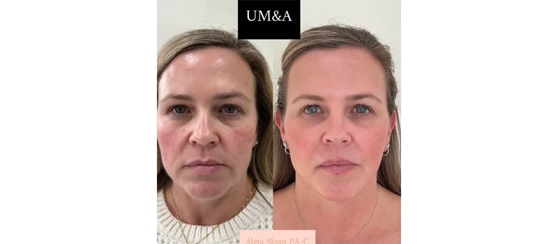 Dermal in Wilmington, NC | United Medical And Aesthetics