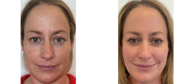 facial rejuvenation