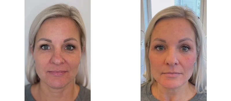 facial rejuvenation