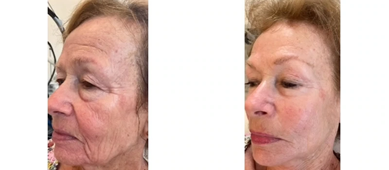 facial rejuvenation