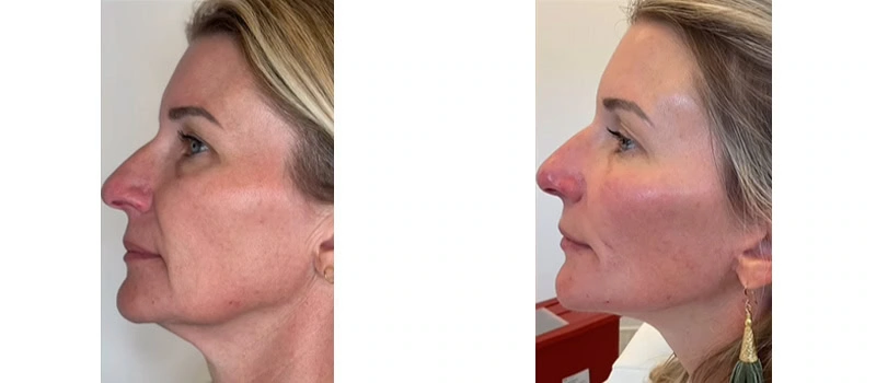 facial rejuvenation