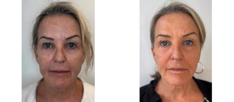 helix co2 laser rejuvenation