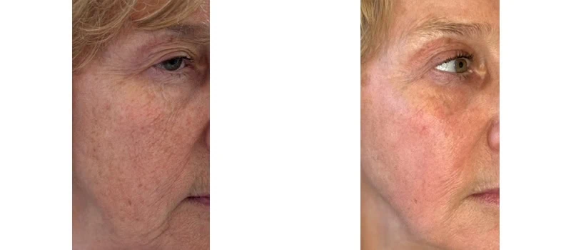 helix co2 laser rejuvenation