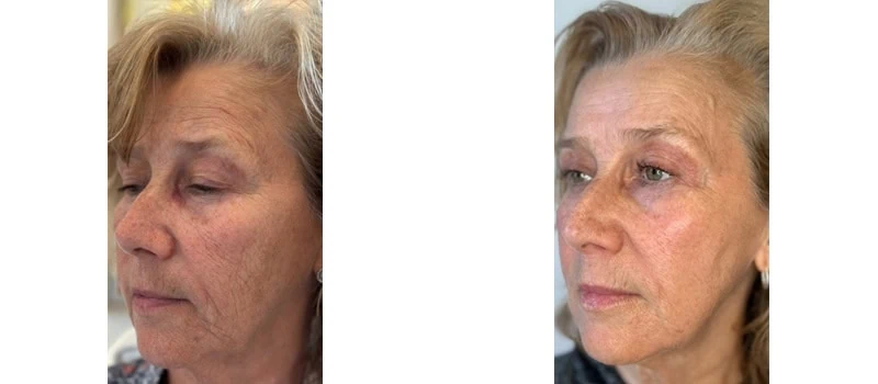 helix co2 laser rejuvenation bna case