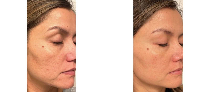helix co2 laser rejuvenation