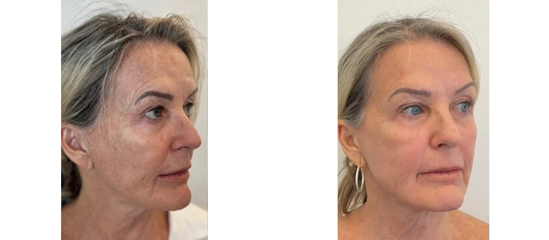 helix co2 laser rejuvenation