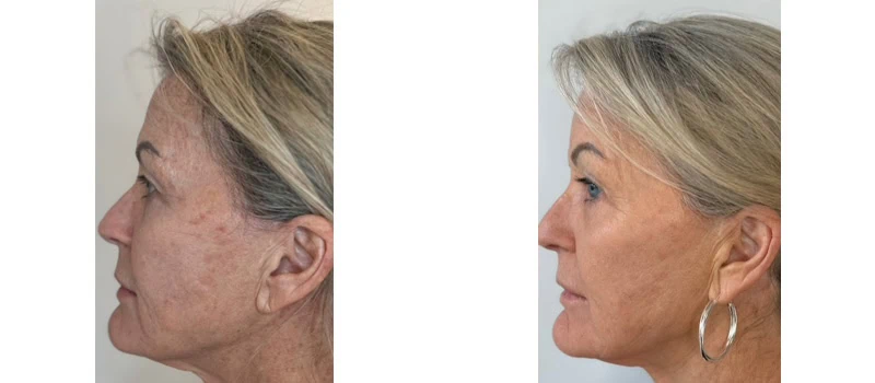 helix co2 laser rejuvenation