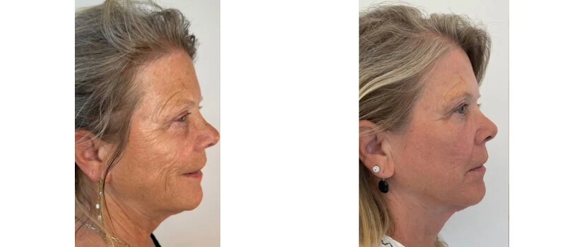 helix co2 laser rejuvenation
