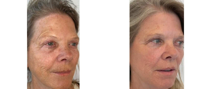 helix co2 laser rejuvenation