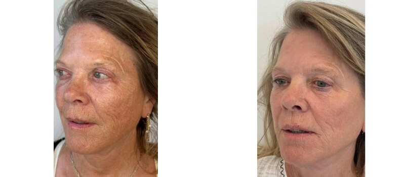 helix co2 laser rejuvenation