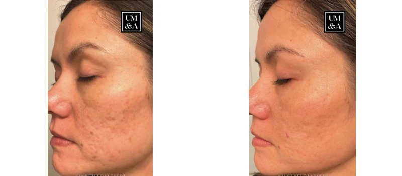 helix co2 laser rejuvenation