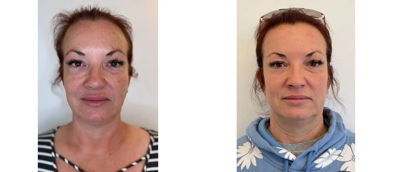 helix co2 laser rejuvenation